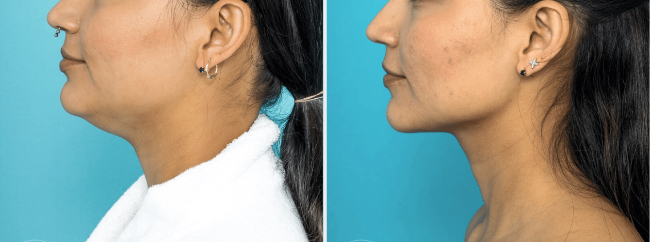 dont-marry-your-double-chin-ideal-bride-wedding-directory